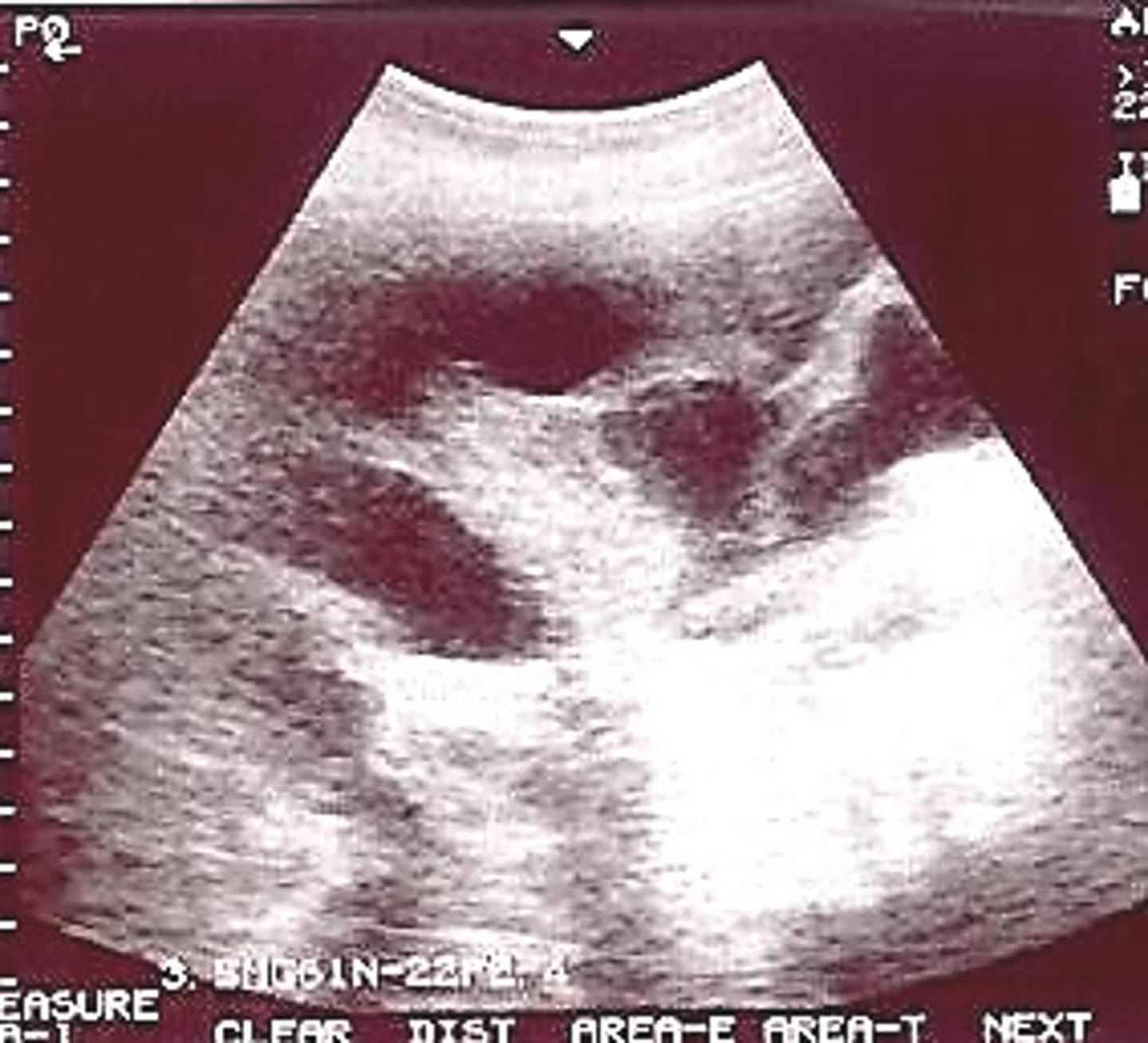 Image 2: At this stage of pregnancy, the fluid in the placental membranes increases considerably, and can be visualized within the uterus.